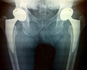 My New Hips